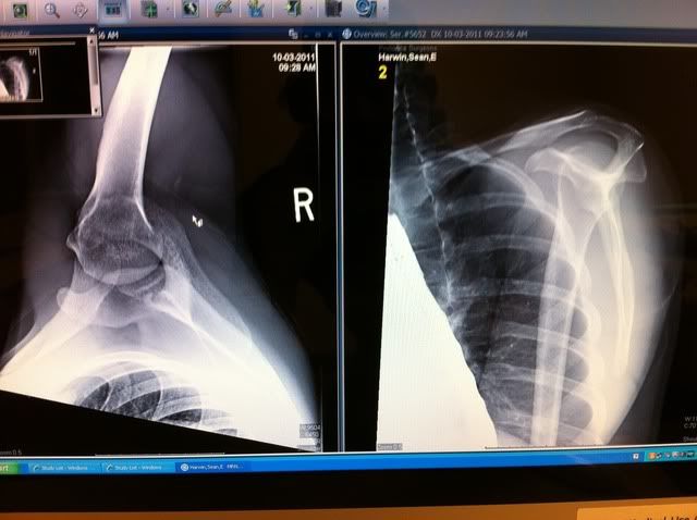 Swollen hands after shooting up