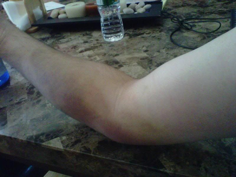 Injury from Blood Draw (pains, bleeding, arm, doctor) Health and Wellness Doctors, illness