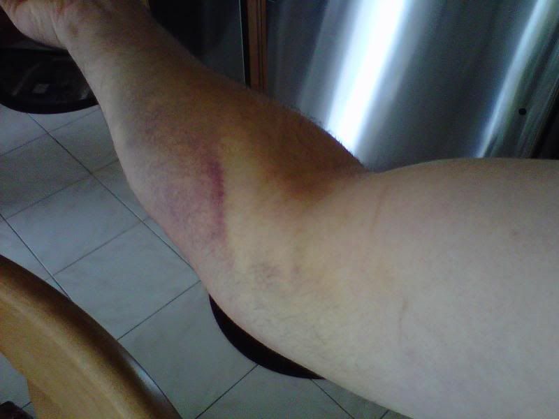 Injury from Blood Draw (pains, bleeding, arm, doctor) Health and