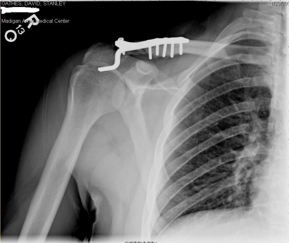 shoulder.jpg