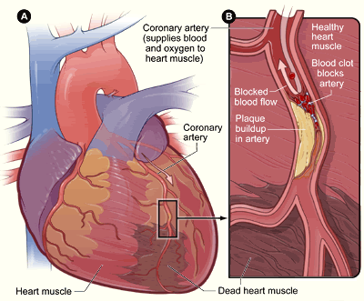 heart attack diagram. HeartAttack.gif image by