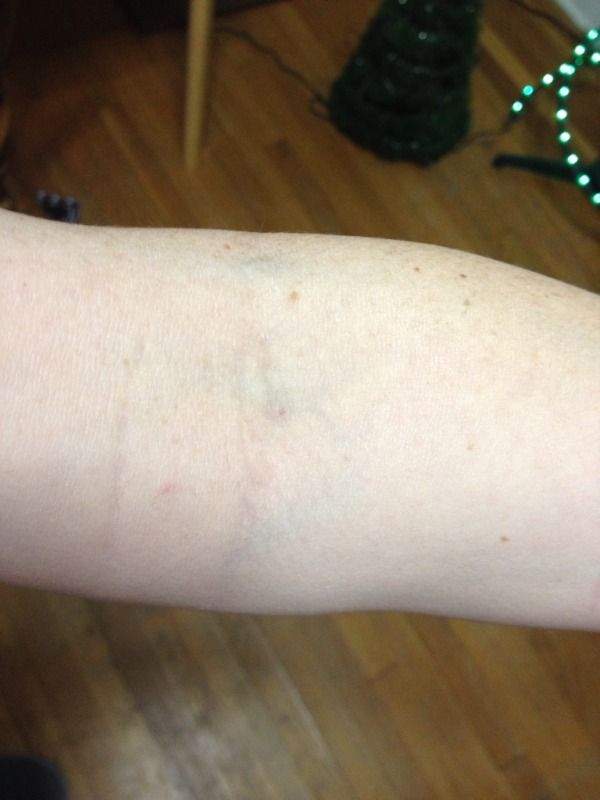 Blood draw gone wrong...ouch! Pictures BabyCenter